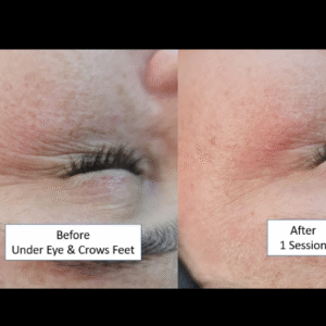 Non-Surgical Needleless Thread Lift